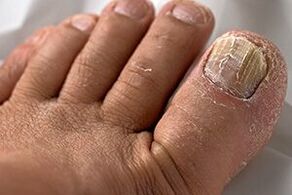 Nail Fungus argazkia